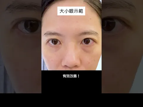 熱銷破萬盒!D-UP雙眼皮貼在日本美妝圈大爆紅零手術感自然雙眼皮!